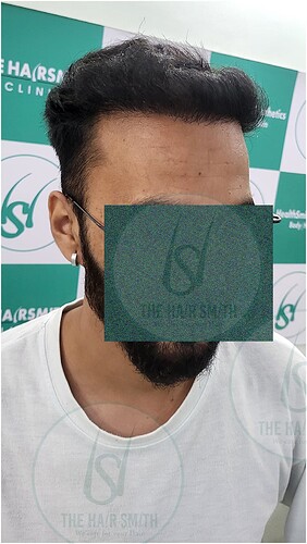 After Hairline Hair Transplant Result 3 in India  form The Hairsmith Clinic