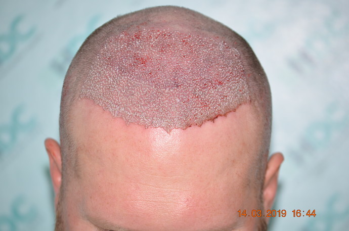 4. Post op FUE1 for 3600 grafts on 14-03-19