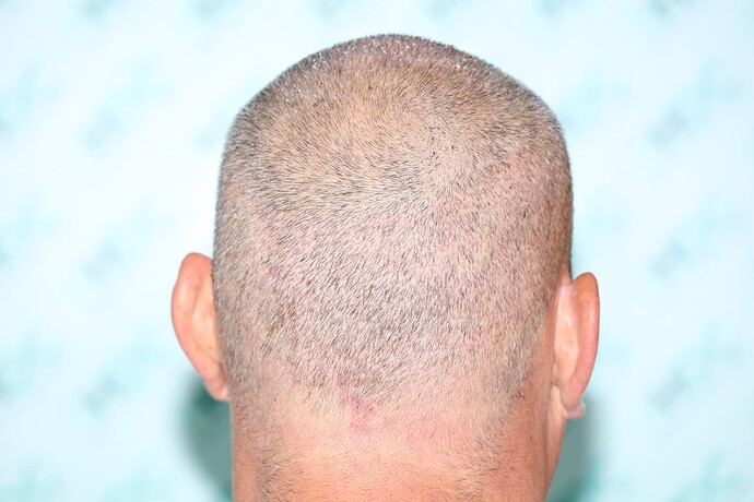 8. Post op Donor - 5 days after FUE2