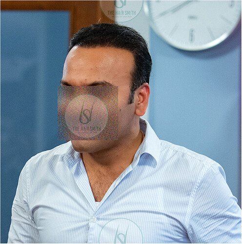 After Best Hair Transplant Result picture 2  - The Hairsmith Clinic - We Care For Your Hair