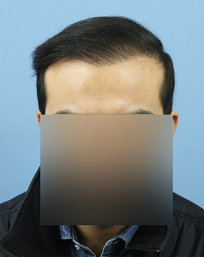 Hair Transplant Result A213 DR as clinic 1