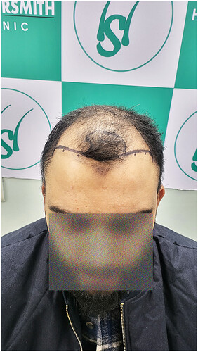 Patient Before Hair Loss Picture (B) at The Hairsmith Clinic