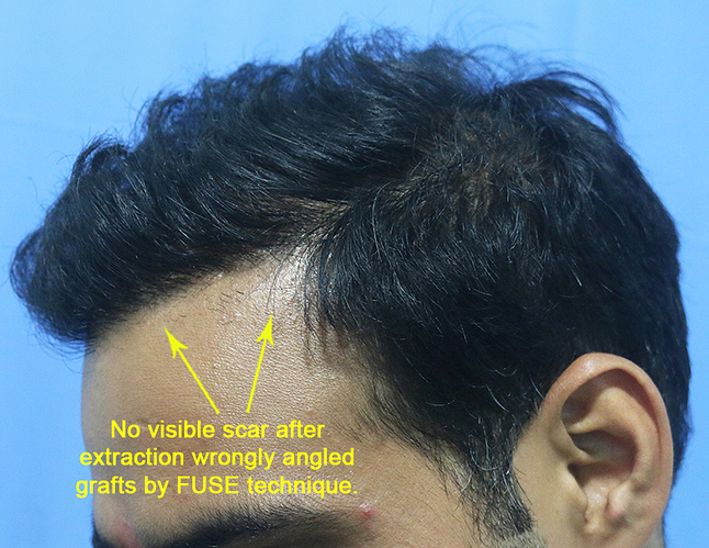 Hair%20Transplant%20Result%20-%20After%20picture%20-%20A215%20-%20drasclinic%20(3)
