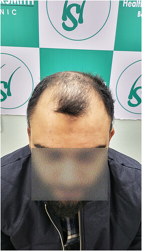Patient Before Hair Loss Picture (A) at The Hairsmith Clinic
