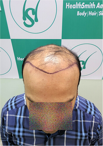 Patient Norwood stages 8 Before  Picture 1 at The Hairsmith Clinic - We Care For Your Hair