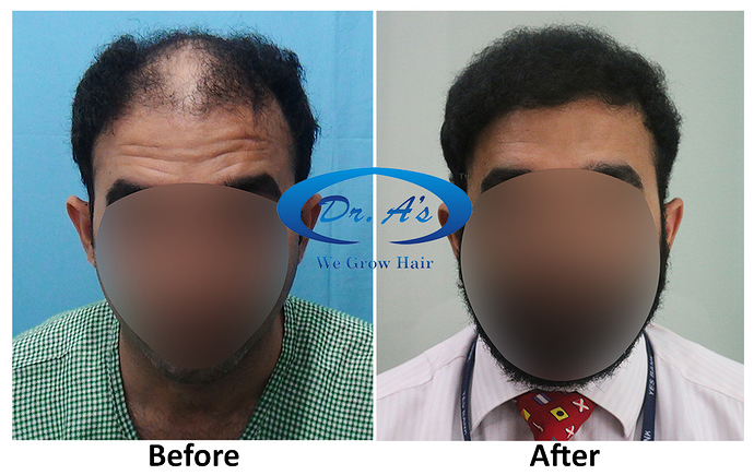 Hair Transplant Result Dr As Clinic  A214 (1)