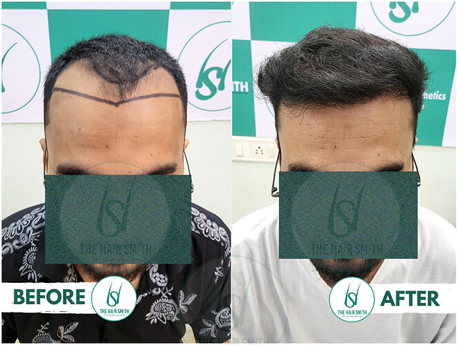 Best Hairline Hair Transplant Result Picture B - The Hairsmith Clinic
