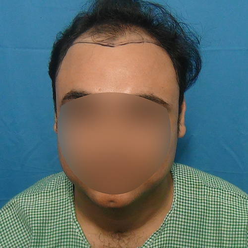 Hair%20Transplant%20Result%20-Before%20picture%20-%20A216%20-%20drasclinic%20(1)