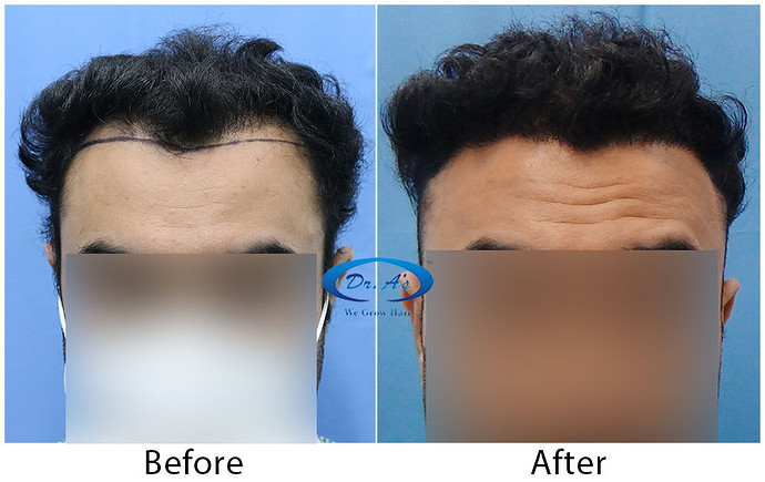 Hair-Transplant-Result(1)-DrAsClinic