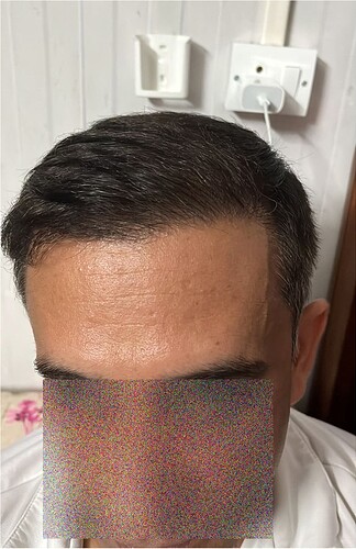 After 7 Months Hair Transplant Picture (2)  The Hairsmith Clinic - We Care For Your Hair
