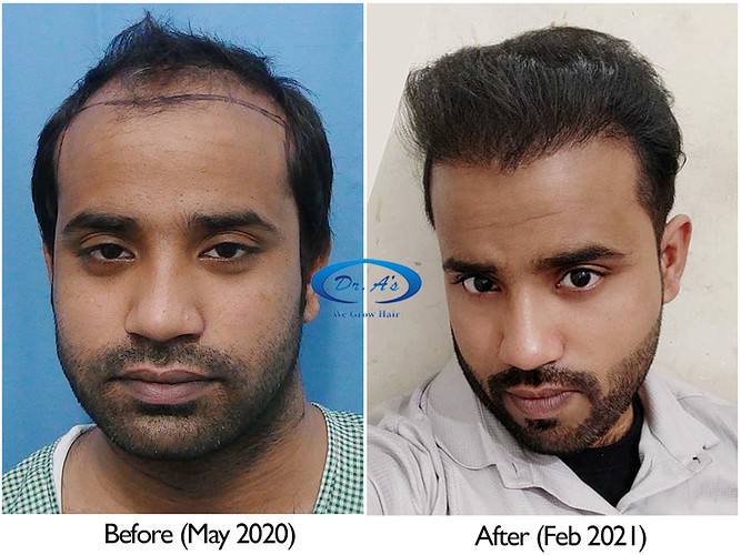 A229 - Hair Transplant Result - DrAsClinic (2)