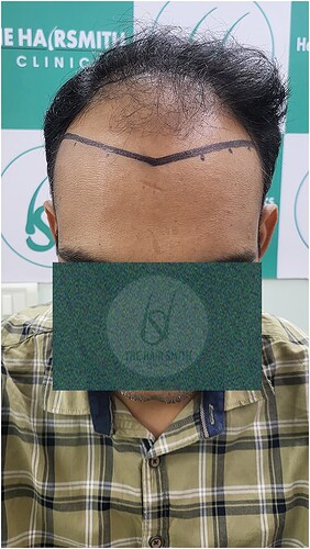 Patient Norwood stages 5 - Before  Picture 2 - The Hairsmith Hair Transplant Clinic