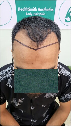 Patient Norwood stages 3 Before  Picture 2 at The Hairsmith Hair Transplant Clinic