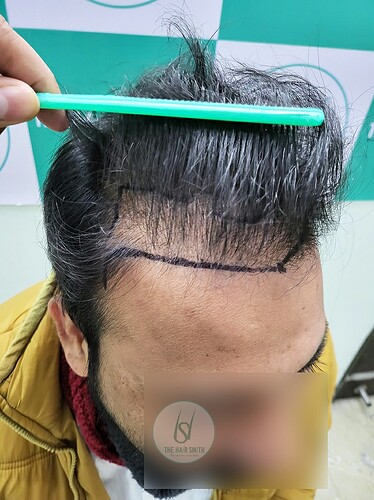 Before After comparison hair transplant result from The Hairsmith Clinic - Hair Transplant Clinic (C)