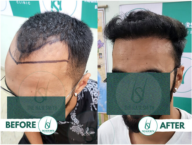 Best Hairline Hair Transplant Result Picture D - The Hairsmith Clinic