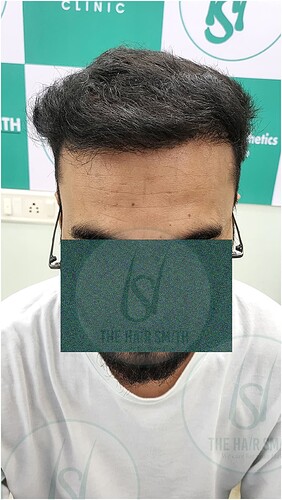 After Hairline Hair Transplant Result 2 in India  form The Hairsmith Clinic