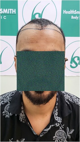 Patient Norwood stages 3 Before  Picture 1 at The Hairsmith Hair Transplant Clinic
