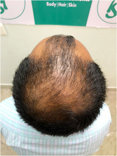 Patient Before Hair Loss Picture 3 at The Hairsmith Hair Transplant Clinic