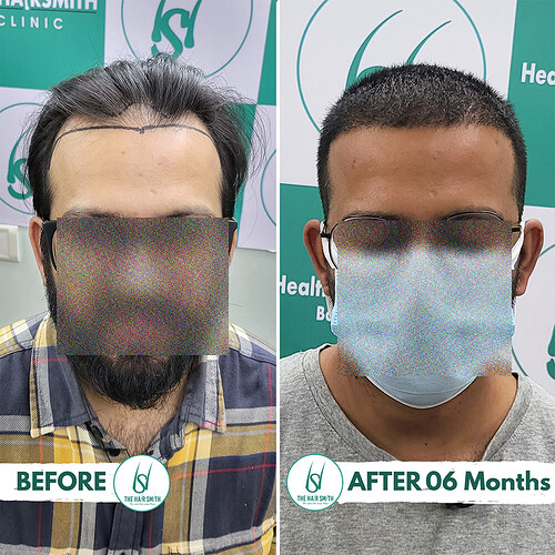 Hair Transplant Result (1)  After 06 Months from The Hairsmith Clinic