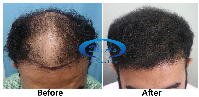 Hair Transplant Result Dr As Clinic  A214 (2)