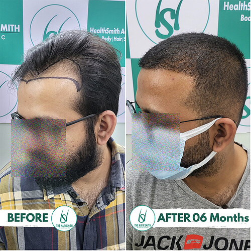 Hair Transplant Result (4)  After 06 Months from The Hairsmith Clinic