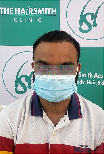 After Hair Transplant Result  Picture A from The Hairsmith Hair Transplant Clinic