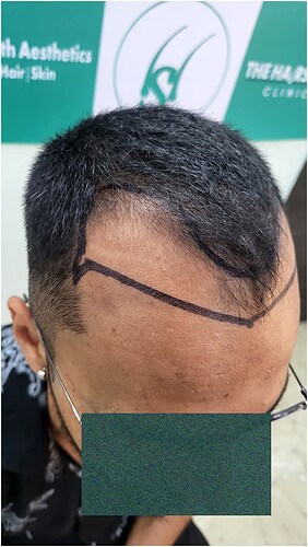 Patient Norwood stages 3 Before  Picture 4 at The Hairsmith Hair Transplant Clinic