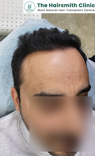 After 12 Months Hair Transplant Results (B)  from The Hairsmith Clinic