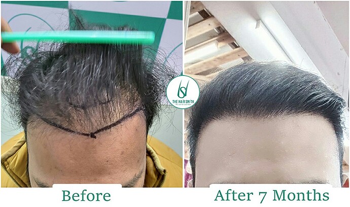 Before After comparison hair transplant result from The Hairsmith Clinic (A)