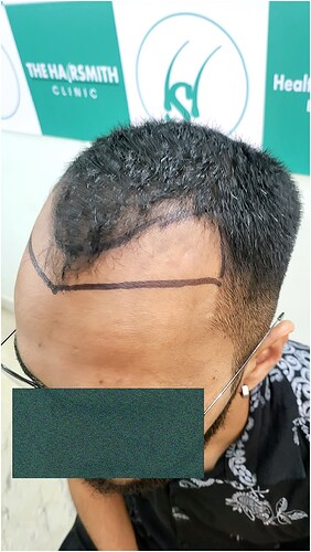 Patient Norwood stages 3 Before  Picture 5 at The Hairsmith Hair Transplant Clinic