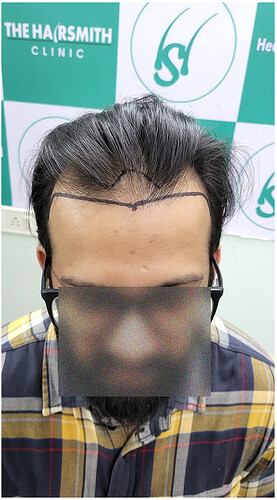 Patient Before Hair Loss Picture 2 at The Hairsmith Clinic - We Care For Your Hair