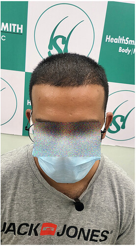 After 6 Months Hair Transplant Picture (1)  The Hairsmith Clinic - We Care For Your Hair