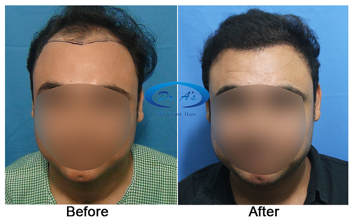 Hair%20Transplant%20Result%20-%20A216%20-%20drasclinic%20(1)