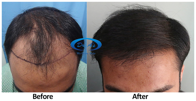 Hair%20Transplant%20Result%20-%20A219%20-%20drasclinic%20(2)
