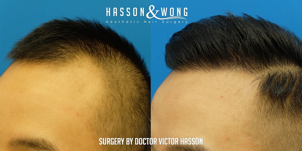 HassonandWong Dr. Hasson FUE Hair Transplant Vancouver 2274 g