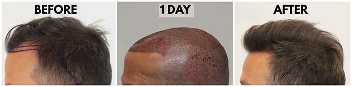 Before-Surgical-After-LeftProfile-New