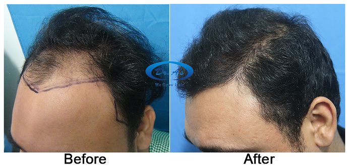 Hair%20Transplant%20Result%20-%20A216%20-%20drasclinic%20(2)