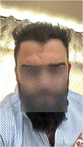 After Hair Transplant Patient Picture (A) at The Hairsmith Clinic