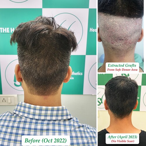 Best Hair Transplant Result  at The Hairsmith Clinic - Most Natural Hair Transplant Centre E
