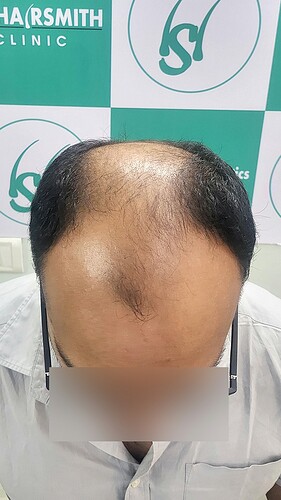 Patient Before Picture (B) form The Hairsmith Clinic - We Care For Your Hair