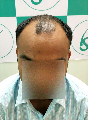 Patient Before Hair Loss Picture 1 at The Hairsmith Hair Transplant Clinic