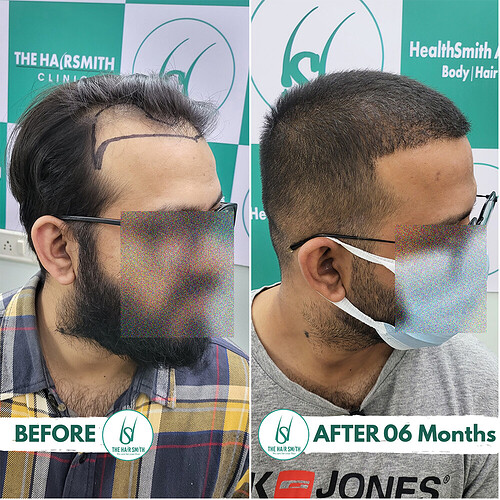 Hair Transplant Result (3)  After 06 Months from The Hairsmith Clinic