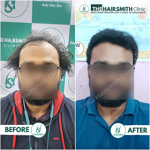 Best Hairline Hair Transplant Result 1 in India  form The Hairsmith Clinic Laxmi Nagar