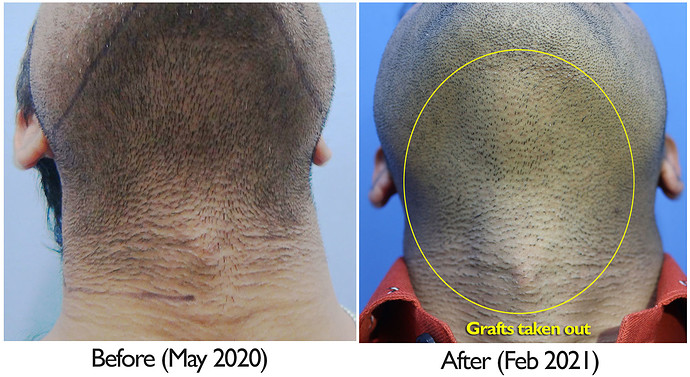 A229 - Hair Transplant Result - DrAsClinic (4)