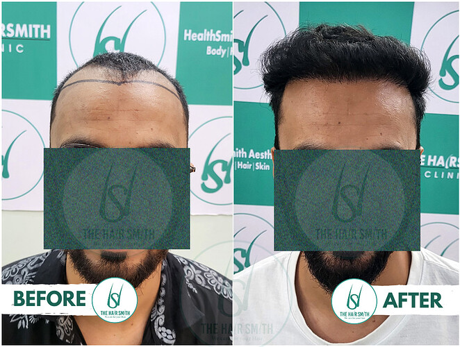 Best Hairline Hair Transplant Result Picture A - The Hairsmith Clinic
