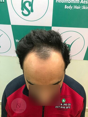 Patient Before Picture (B)  from The Hairsmith - Best Hair Transplant Centre
