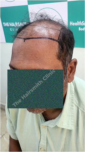 Patient Norwood stages 8 Before  Picture 3 at The Hairsmith Hair Transplant Clinic