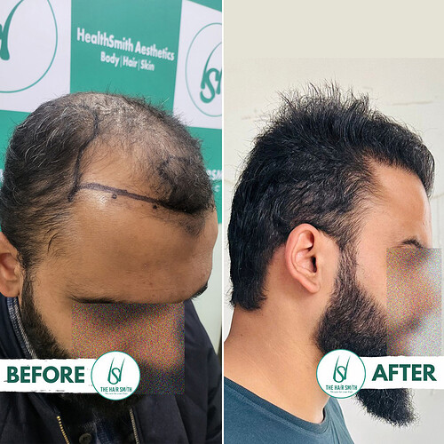 Best Hair Transplant Clinic in Delhi - Best Hair Transplant clinic in India - Best Hair Transplant Doctor in Delhi - Best Hair Transplant Doctoe in India - The Hairsmith Clinic - 2
