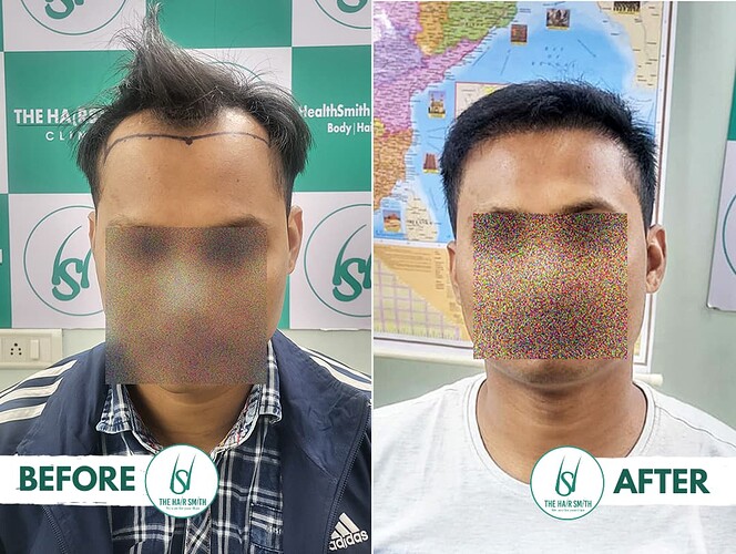Best Hairline Hair Transplant Result in India  form The Hairsmith Clinic Laxmi Nagar