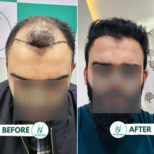 Best Hair Transplant Clinic in Delhi - Best Hair Transplant clinic in India - Best Hair Transplant Doctor in Delhi - Best Hair Transplant Doctoe in India - The Hairsmith Clinic - 1